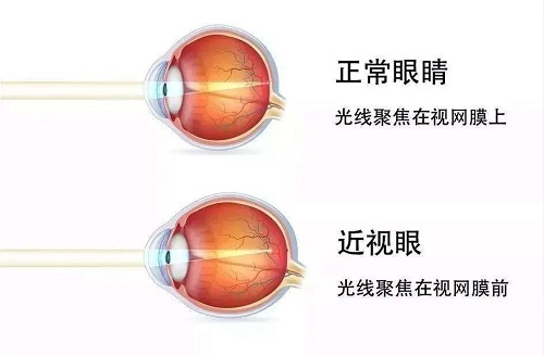 近视可以不戴眼镜吗？