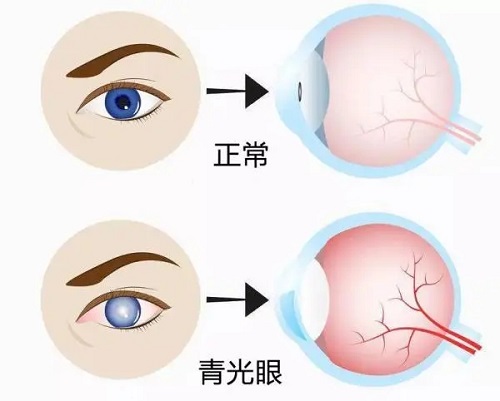 青光眼会损伤视神经吗？